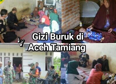 Tiga Anak Gizi Buruk Kembali Ditemukan di Aceh Tamiang